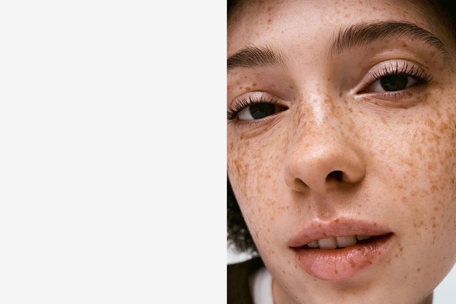 Acne & Onzuiverheden